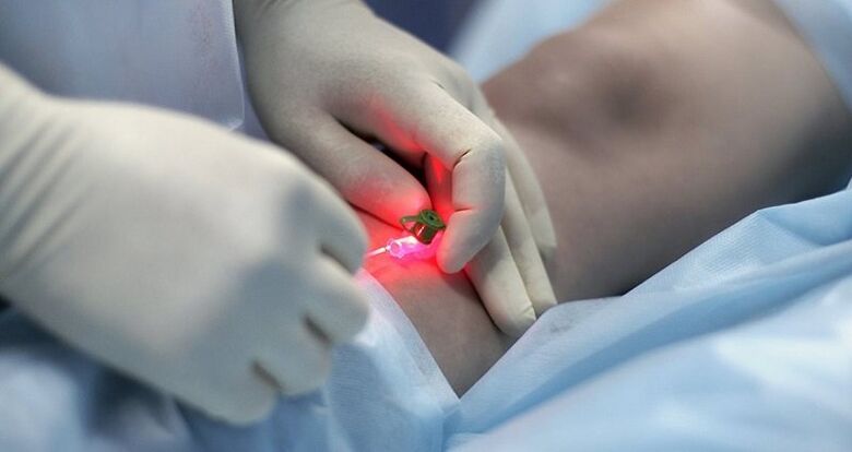 Хируршки третман на проширени вени